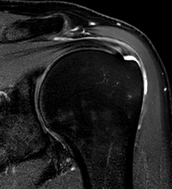 superior capsule Philippe Marti